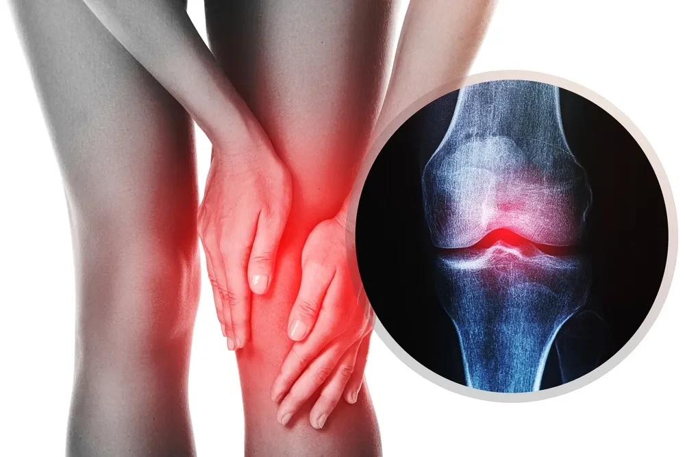 fibromyalgia knee pain