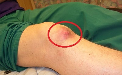 Gout in Knee: Signs, Causes, Impacts and Treatment