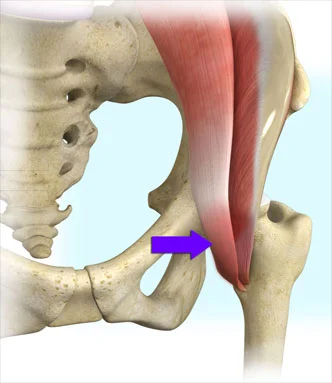 Managing Iliopsoas Tendonitis: A Comprehensive Guide to Treatment