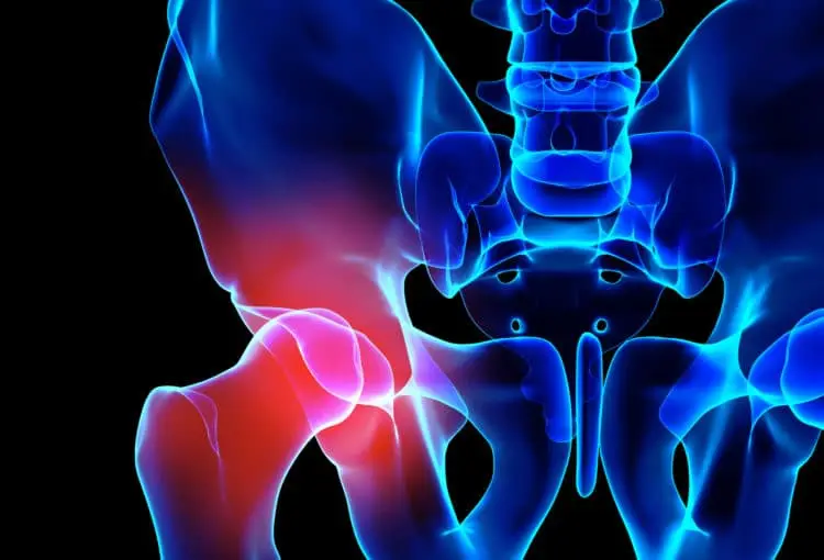 hip pointer injury
