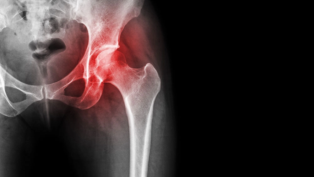 hip rheumatoid arthritis