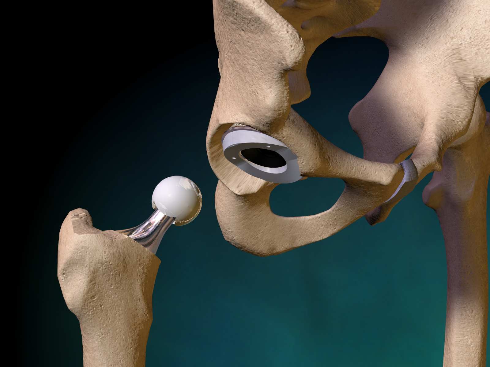 Hip Replacement Pain: Why It Happens, Tips To Relieve Pain