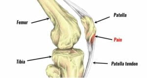 What is Jumper's Knee? Understanding the Strain