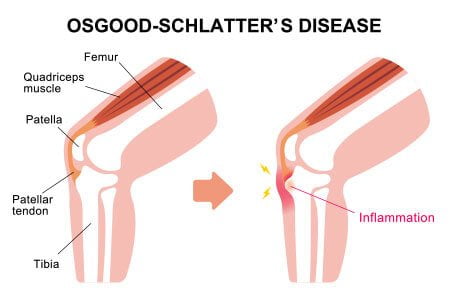 Osgood Schlatter Disease - Understanding and Treatment