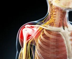 Preventing Bilateral Shoulder Pain