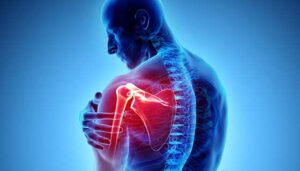 Types of Shoulder Arthritis
