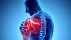 Types of Shoulder Arthritis