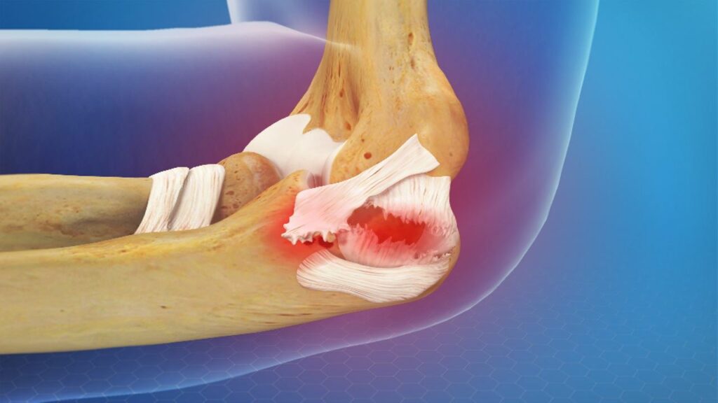 Elbow Ligament Injuries: Causes, Treatment, and Recovery