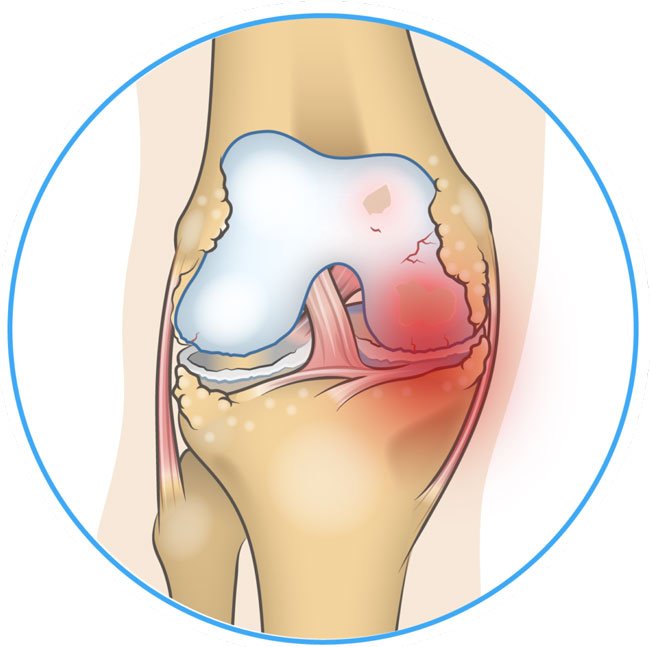 Bone-on-Bone Knee Pain: Causes, Symptoms, and Management