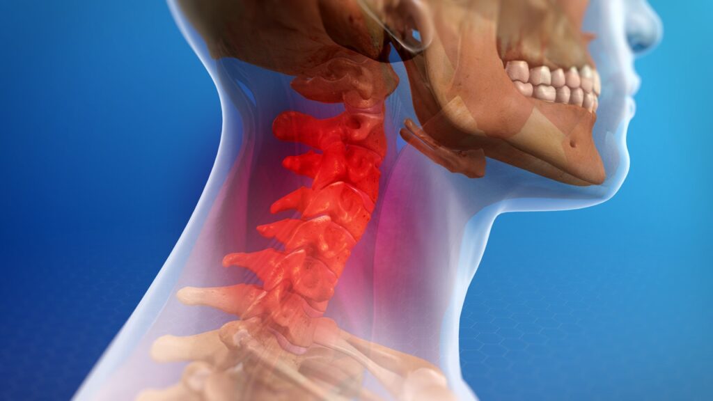 Whiplash Injury and Its Effective Treatments