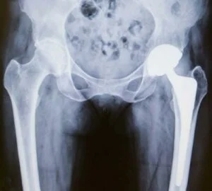 What Are The Stages of Hip Replacement Physical Therapy?