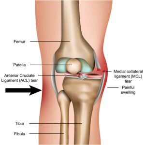 Benefits of Physical Therapy for MCL Injuries