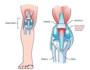 Benefits of Physical Therapy for Patellar Tendonitis