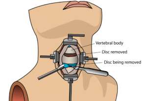 Finding the Right Cervical Spine Specialist Near You