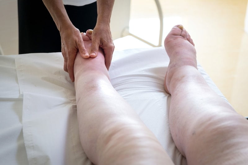 Lymphedema Physical Therapy: Empowering Recovery