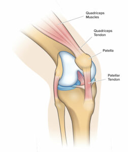 Techniques of Physical Therapy for Patellar Tendonitis