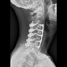 Treatment Options by Cervical Spine Specialist