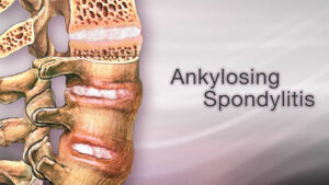Understanding Ankylosing Spondylitis