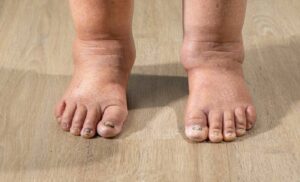 Understanding Complex Regional Pain Syndrome 