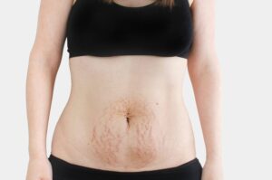 Understanding Diastasis Recti
