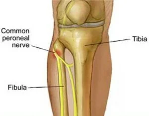 Understanding Knee Nerve Pain