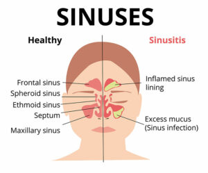 Understanding Sinus Pain