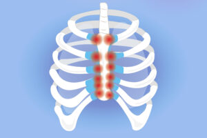 What Is Costochondritis?