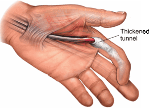What Is Trigger Finger?