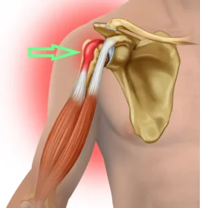 What is AC Joint Arthritis