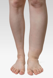 What is Lymphedema?