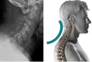 When to Consider a Cervical Spine Specialist