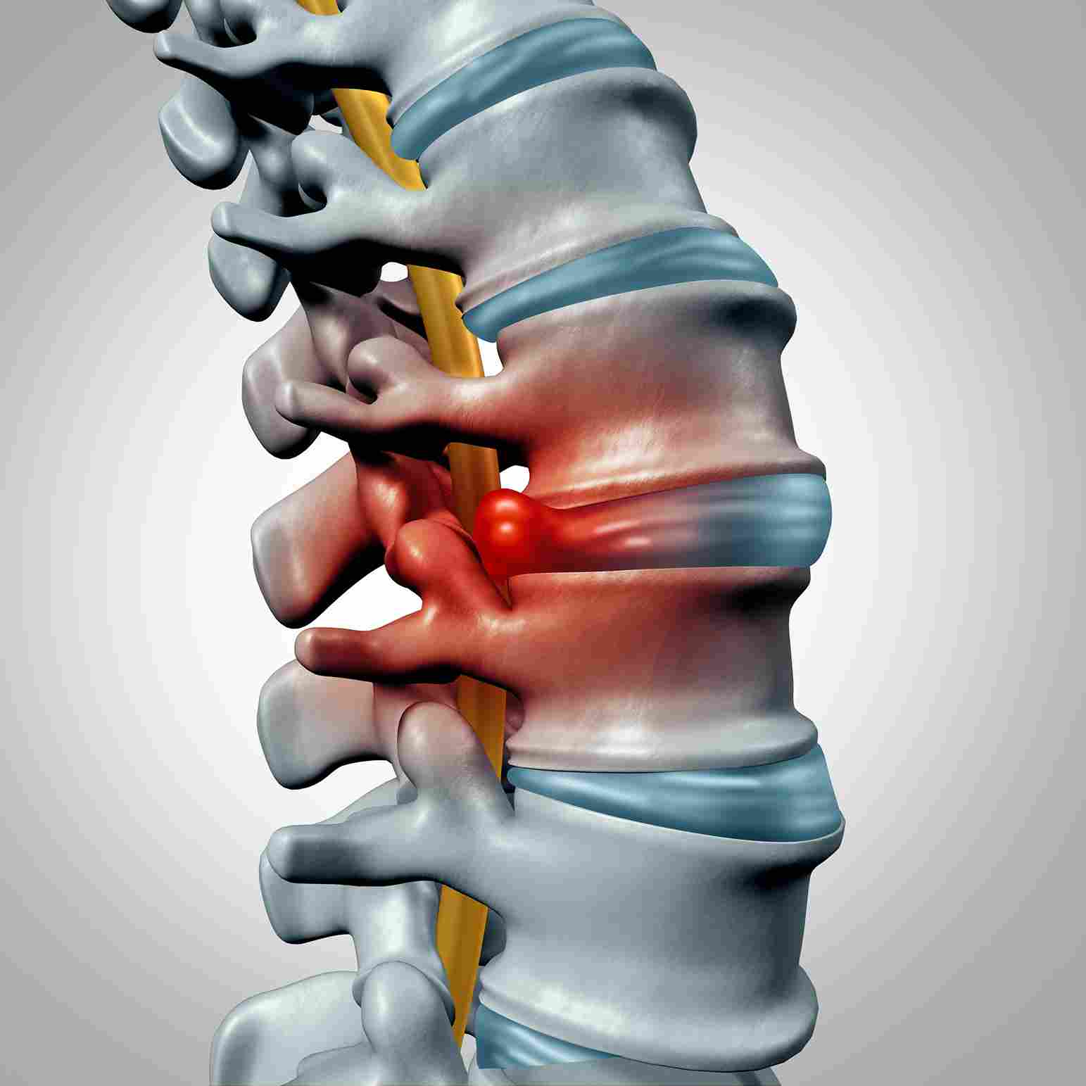 L4 L5 Pain: How It Feels, Causes, Treatment And Exercises