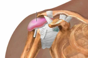 What Triggers Bursitis In Shoulder?