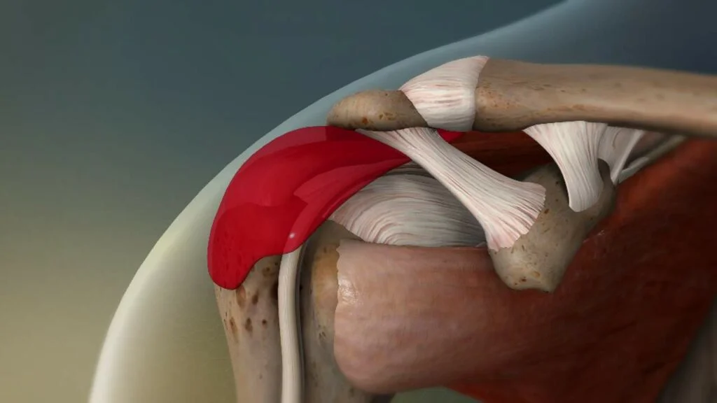 Subacromial Bursitis: Unraveling the Mystery of Shoulder Pain