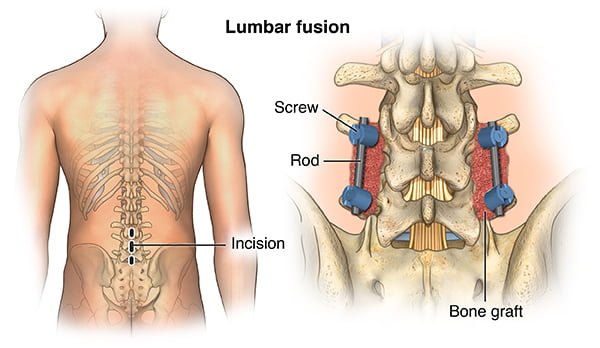Lumbar Spinal Stenosis and Its Treatments