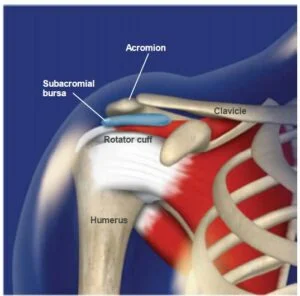What Is Subacromial Bursitis?