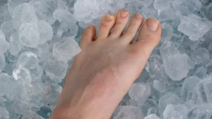 ice therapy