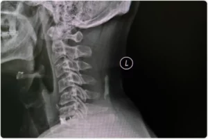 Physiotherapy Techniques For Cervical Spondylosis