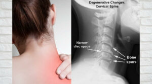 The Role of Physiotherapy